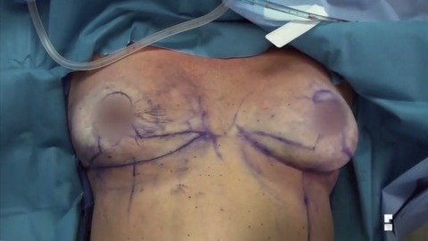 Pic: Nicole Eggert in Botched