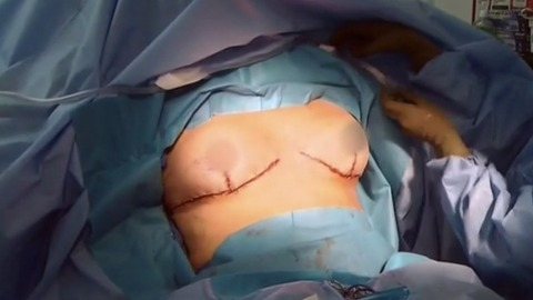 Pic: Nicole Eggert in Botched