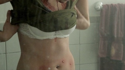 Pic: Lacy Fisher in Chemical Peel