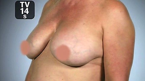 Pic: Nicole Eggert in Botched