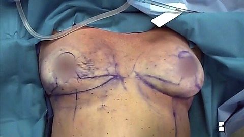 Pic: Nicole Eggert in Botched