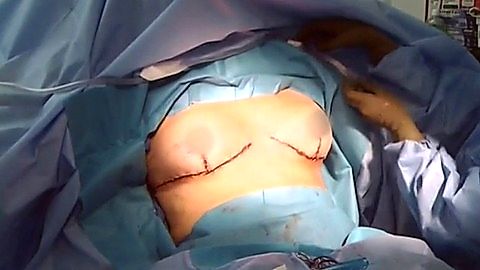 Pic: Nicole Eggert in Botched